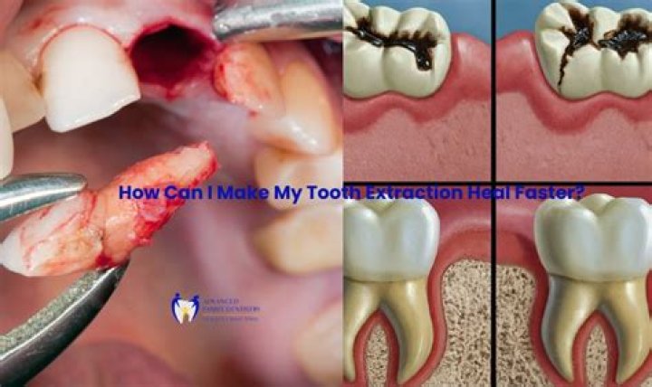 How much bleeding is normal after wisdom teeth removal?