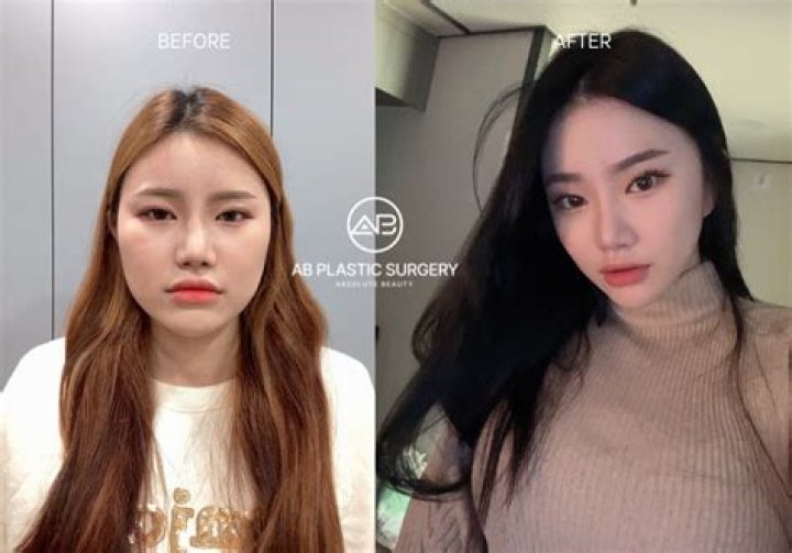 How much does cheekbone surgery cost?