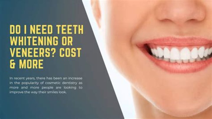 How much does it cost for your teeth to be professionally whitened?