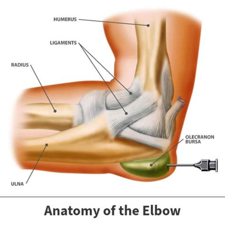 How painful is olecranon bursa?
