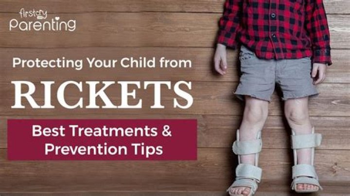 How rickets affect teeth?