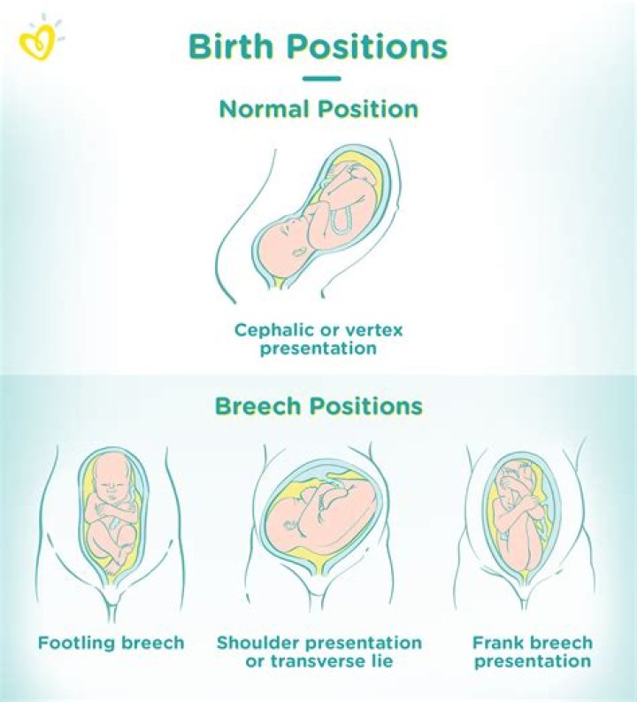 Is breech position normal at 20 weeks?