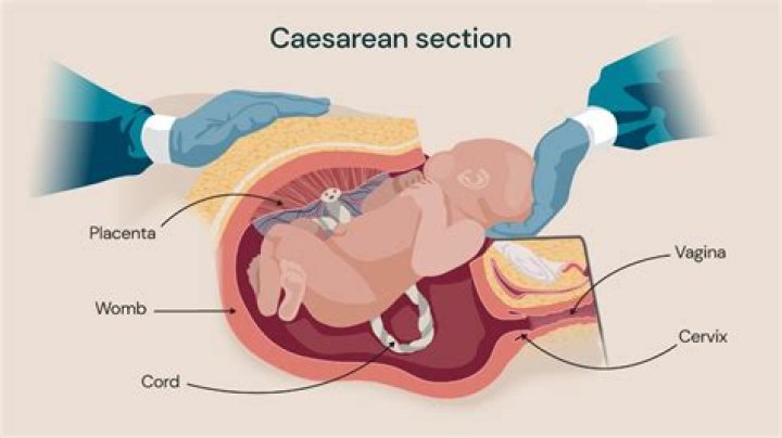 Is it normal for a cesarean incision to leak?