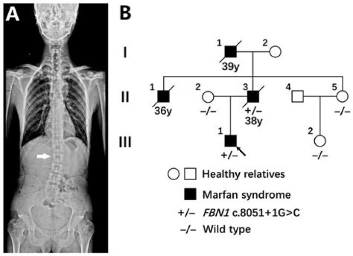 Is Marfan syndrome a substitution mutation?
