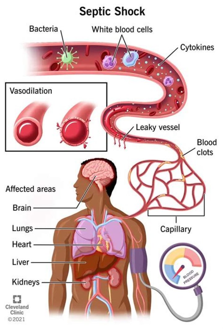 Is septicemia a blood infection?