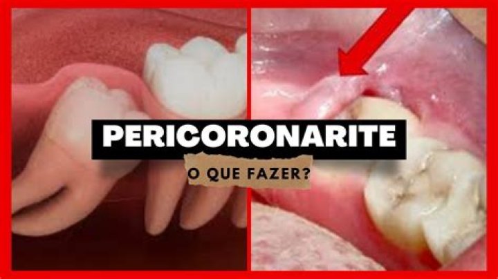 O que e uma pericoronarite?