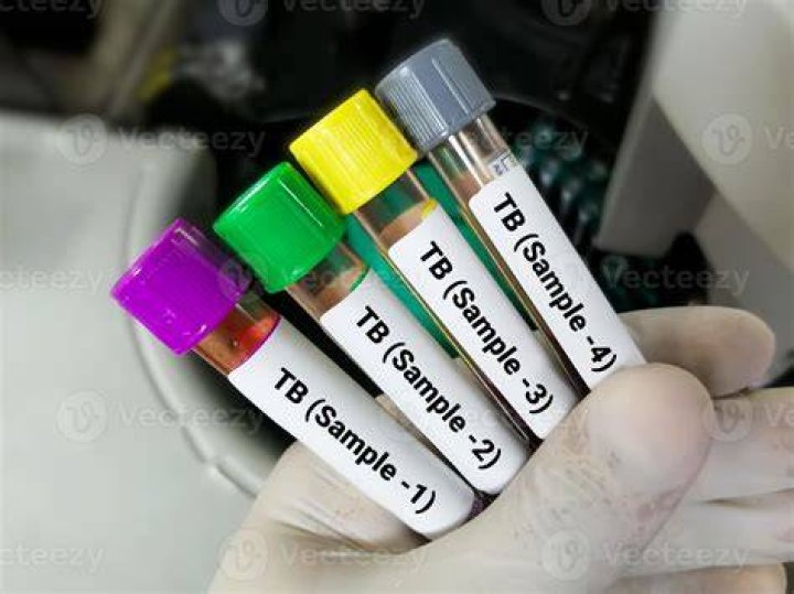 Tem para TB?