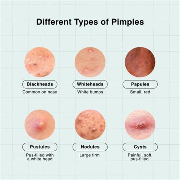 What are bumps that look like pimples?