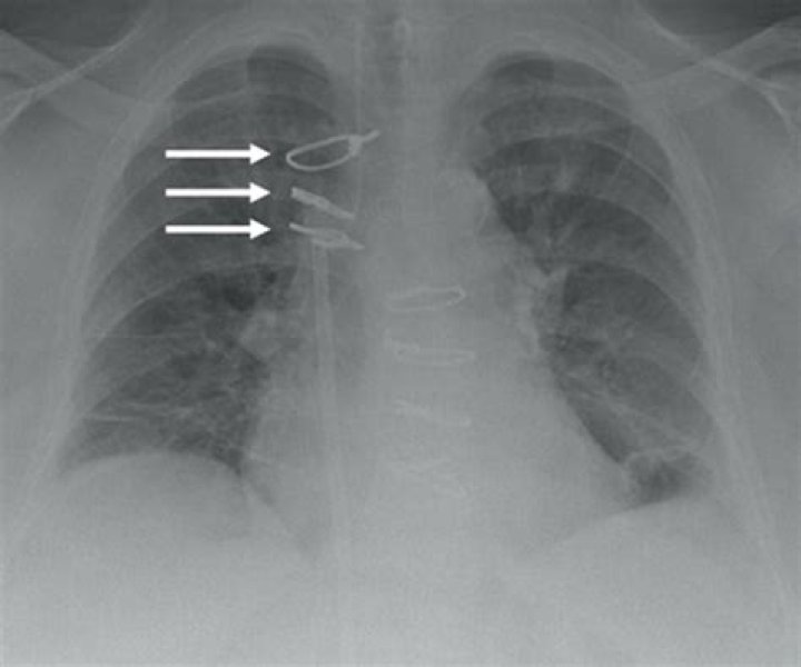 What are CABG clips?