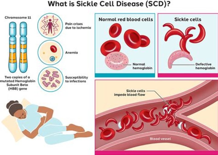 What can cause anemia in a child?