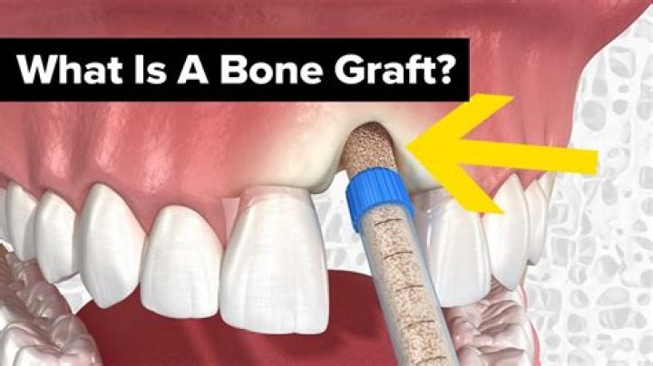 What can go wrong with dental bone graft?