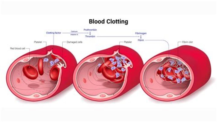 What causes blood clots after delivery?