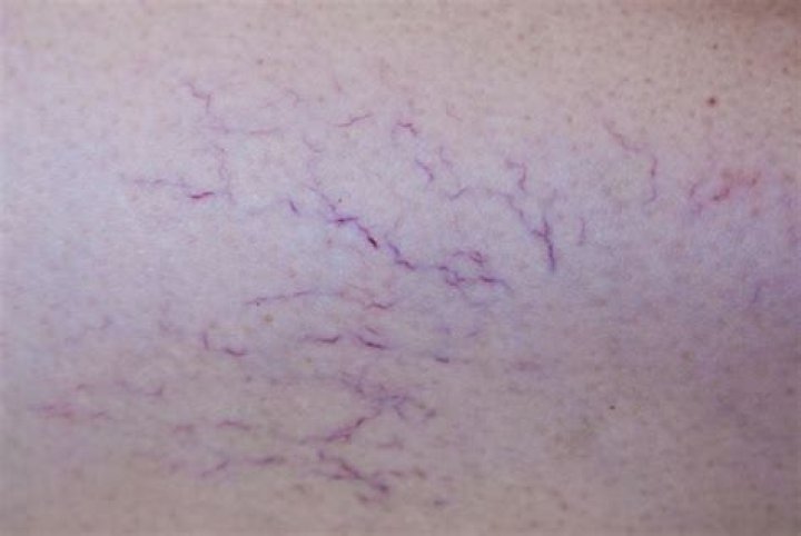 What causes broken capillaries on breast?