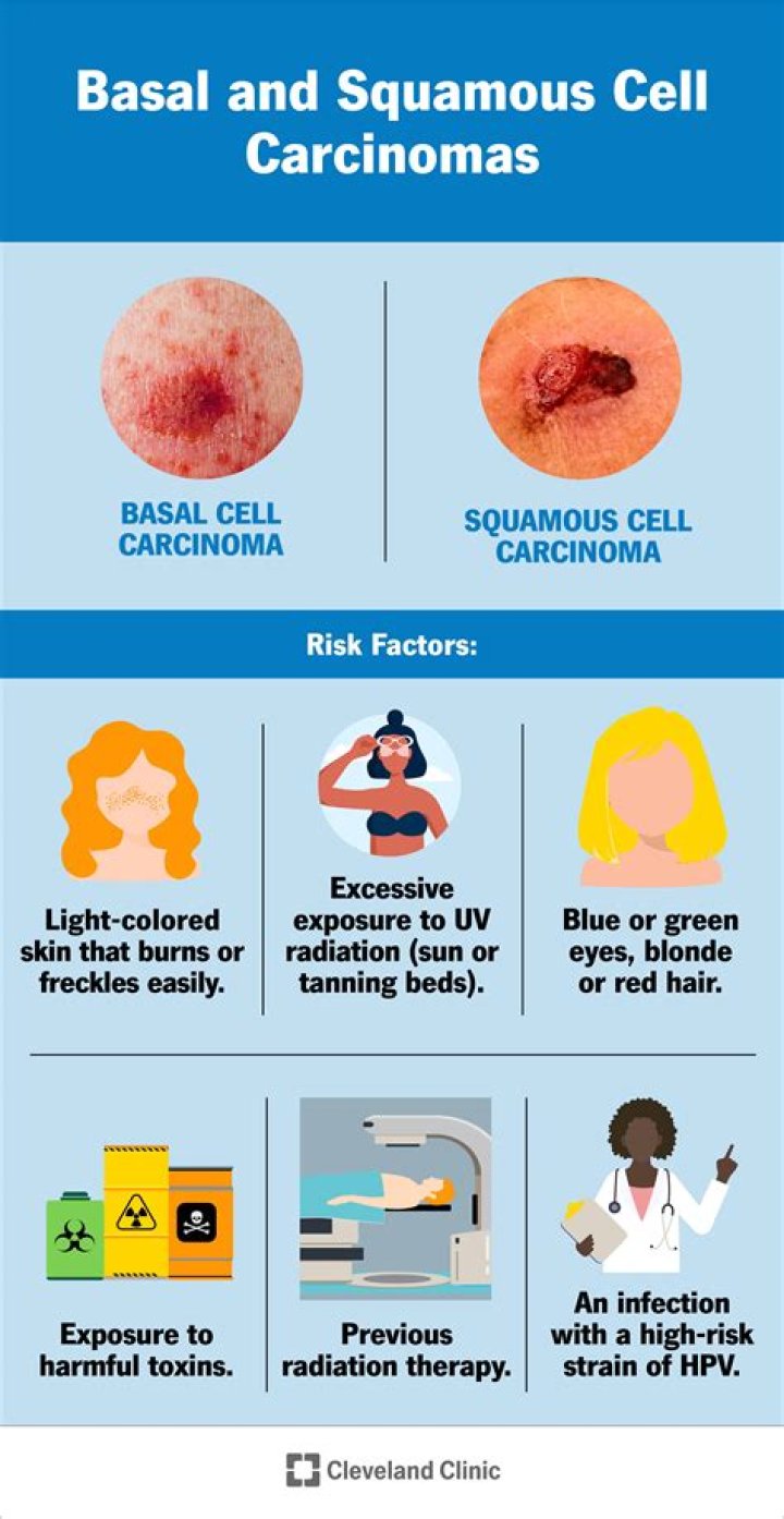 What causes carcinoma?