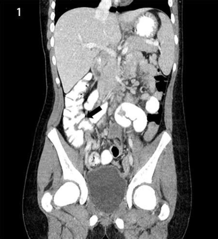 What causes ileocolitis?