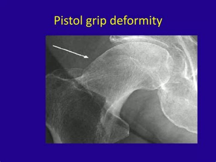 What causes pistol grip deformity?