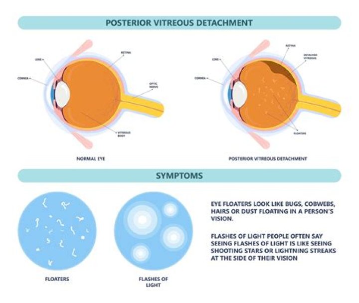 What causes purple spots in your vision?