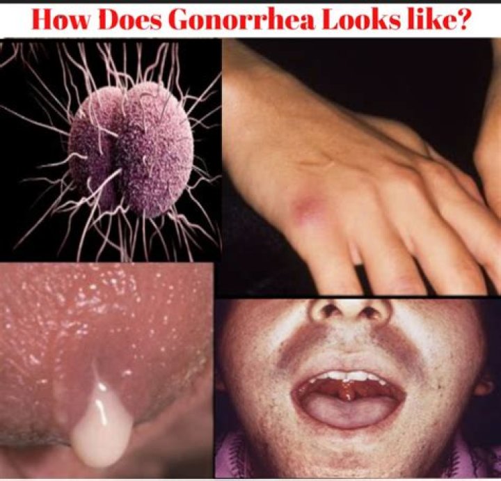 What clears away gonorrhea?