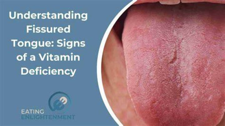 What do tongue fissures look like?