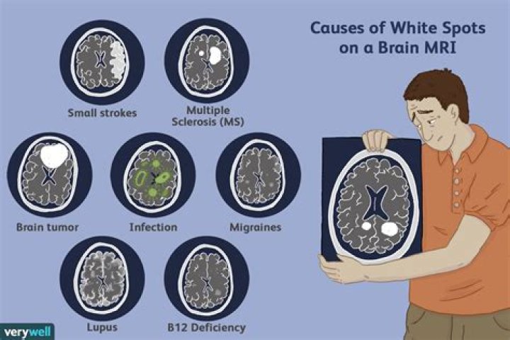 What do white spots on spine MRI mean?
