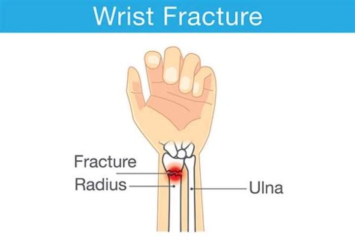 What does a wrist fracture feel like?