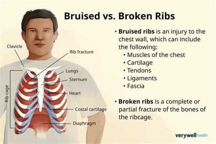 What does bruising on the ribs mean?
