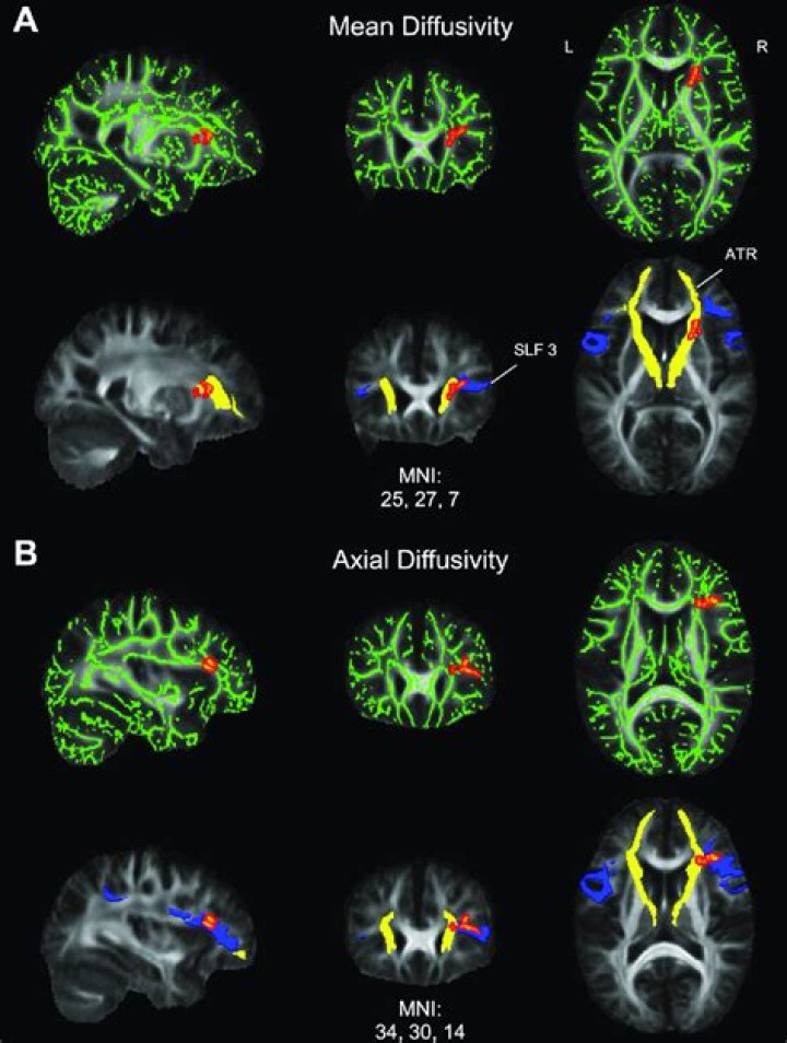 What does diffusion tensor imaging detect?