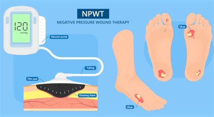What does NPWT stand for?