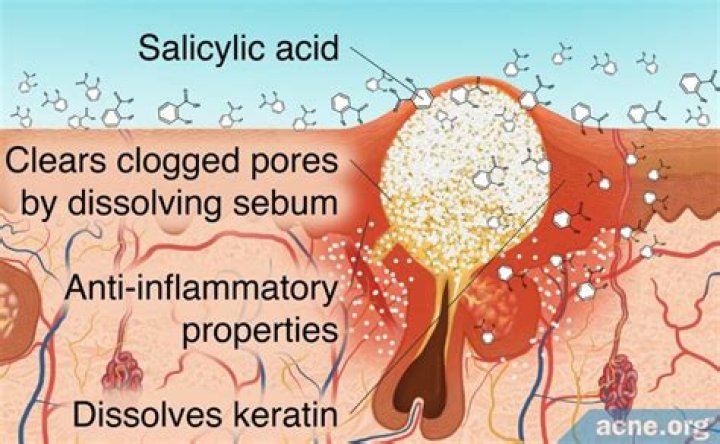 What does salicylic acid do to skin?