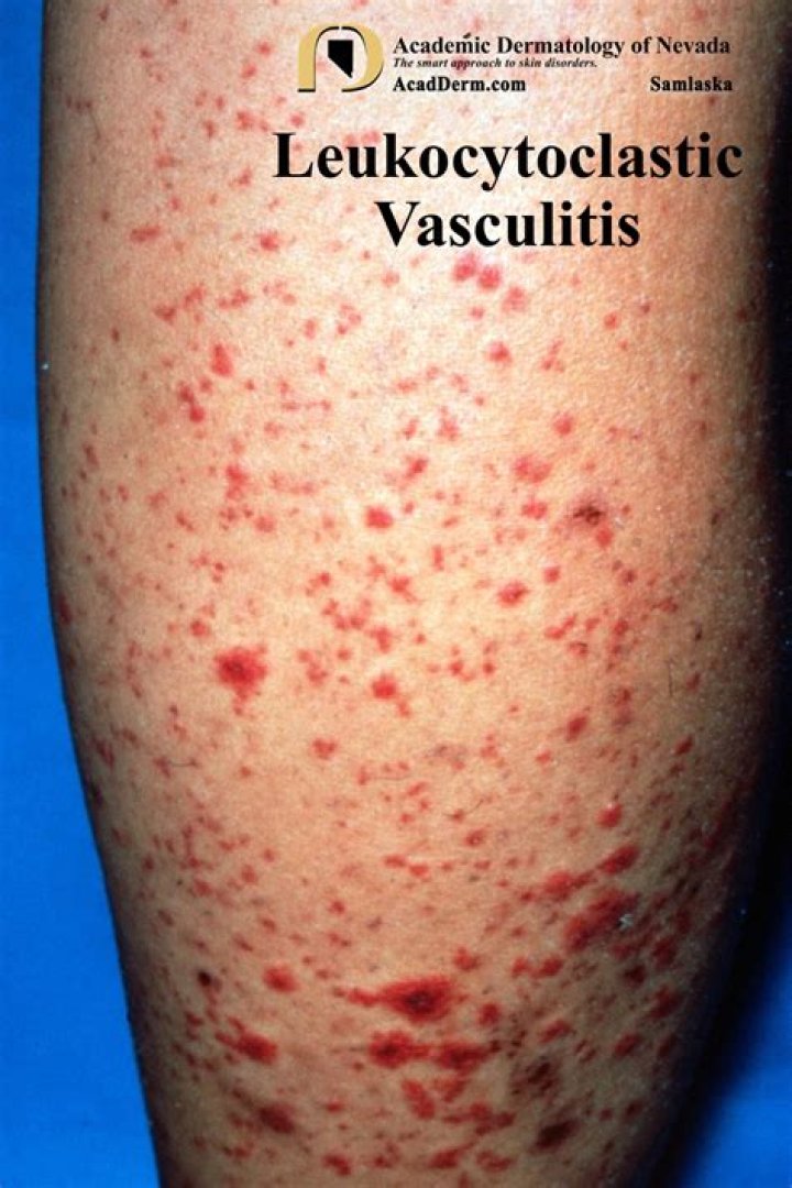 What does vasculitis look like?