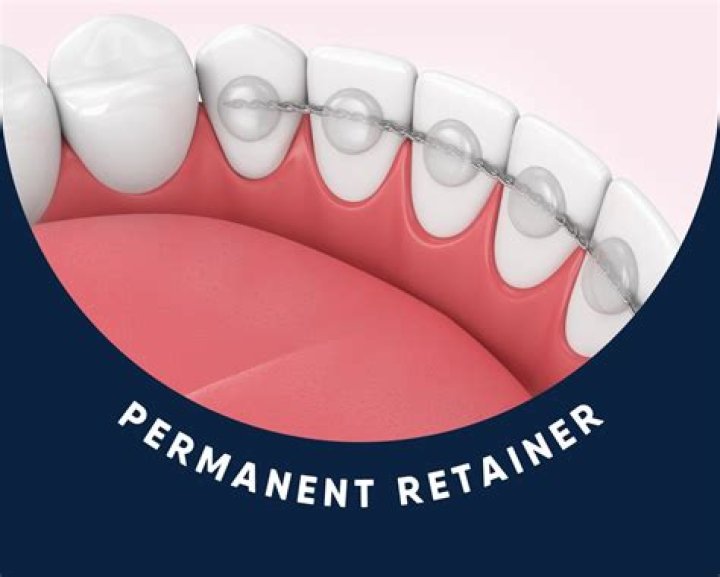 What happens if my retainer wire breaks?