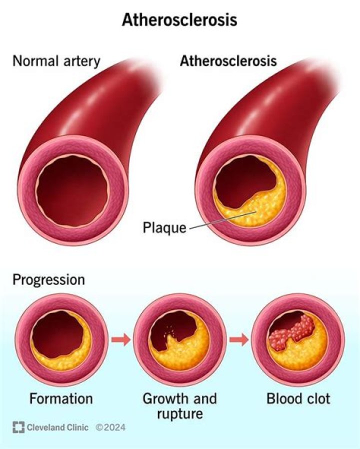What happens when you have arteriosclerosis?