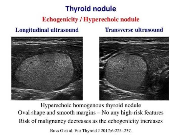 What is a hypoechoic nodule on ovary?