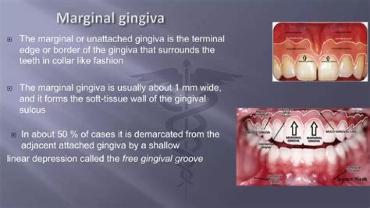 What is a marginal gingiva?