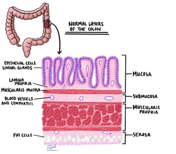 What is a nodular mucosa in colon?
