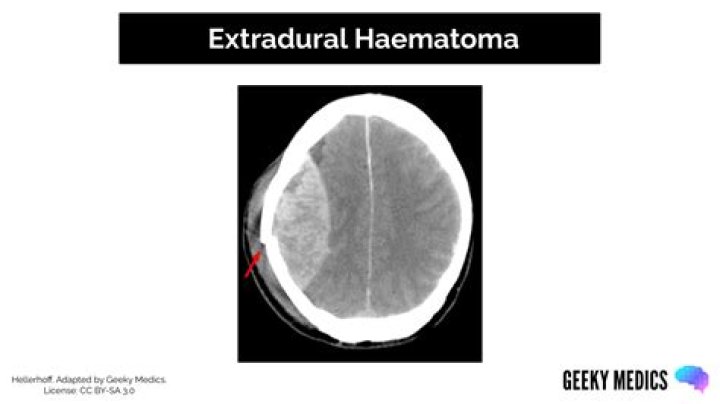 What is a orbital hematoma?