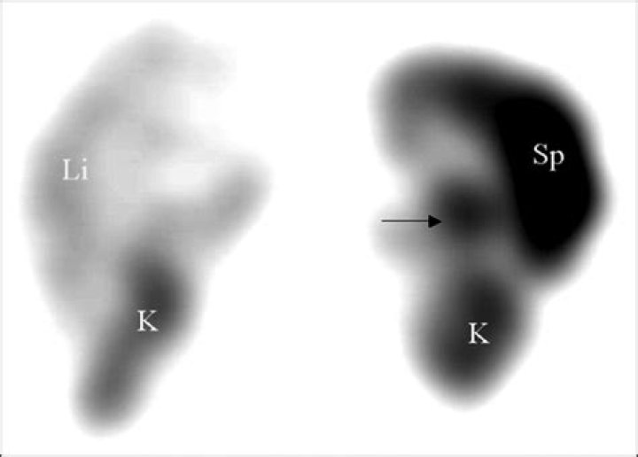 What is a splenunculus?