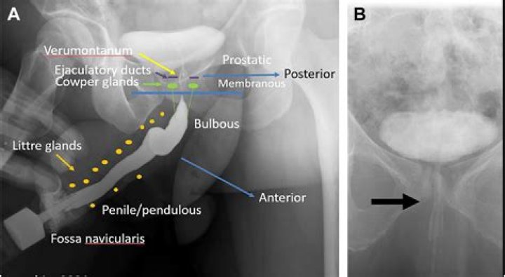What is a voiding Cystourethrogram used for?