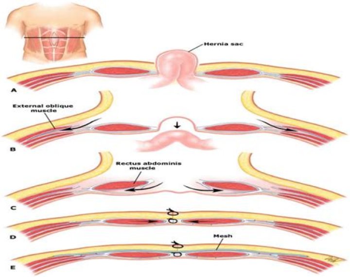 What is abdominal wall eventration?