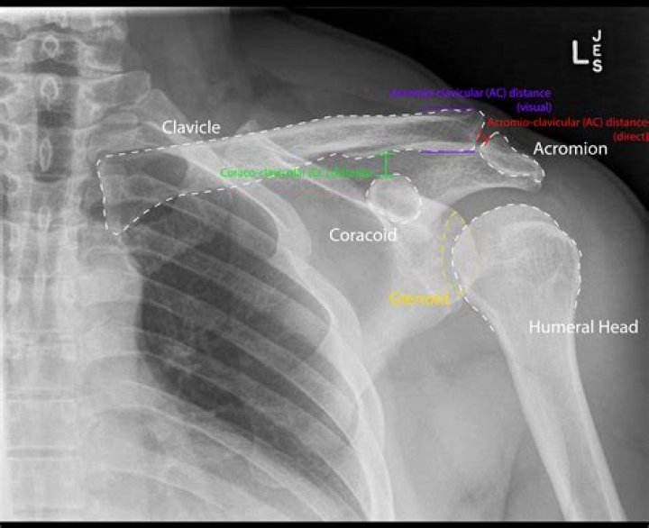 What is an acromioclavicular dislocation?