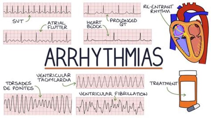 What is arrhythmia PPT?