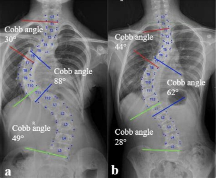 What is Cobb angle used for?
