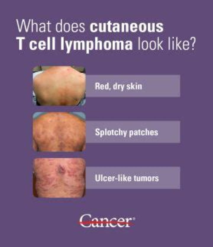 What is cutaneous Pseudolymphoma?