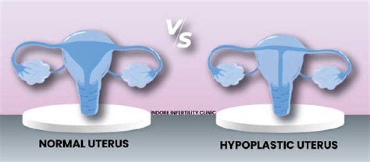 What is hypoplastic uterus?