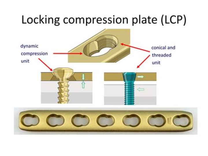 What is locking compression plate?