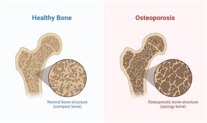 What is osteomalacia caused by?