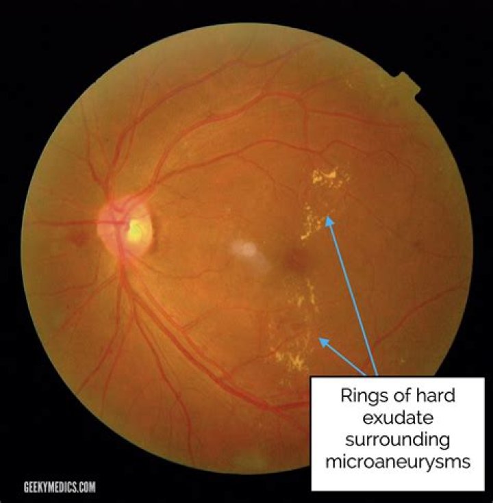 What is retina exudate?