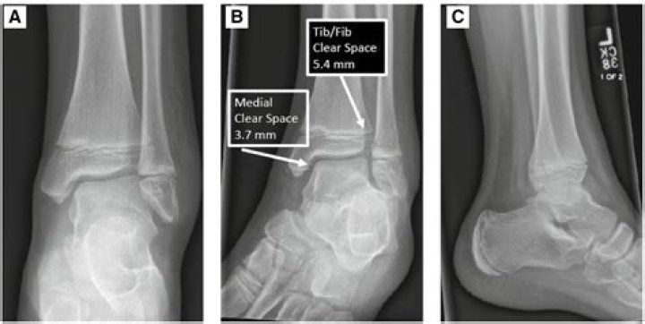 What test evaluates for a syndesmosis ankle sprain?