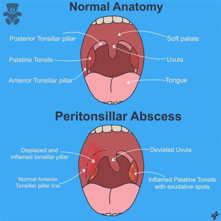 What would cause an abscess in your throat?