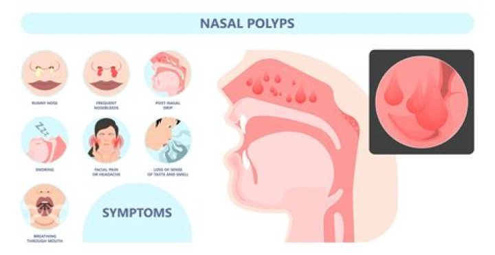 Where do nasal polyps arise from?